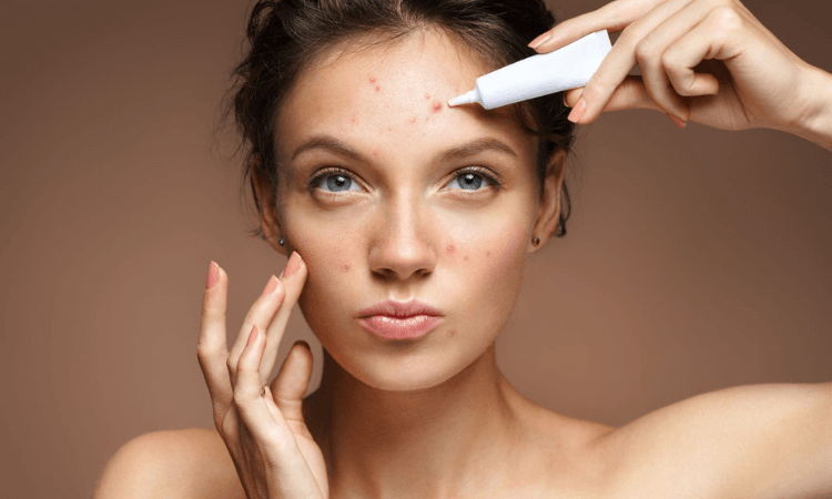 best-acne-creams