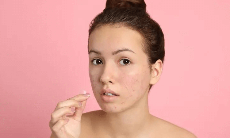 best-soap-for-pimples-and-acne-breakouts